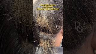 How to remove lice from hairhow to treat lice amp nitslice removallice treatment in Coimbatorelice [upl. by Atselec]