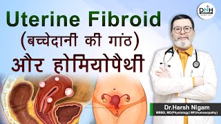 Uterine fibroid  बच्चेदानी की गांठ  और होमियोपैथी  uterine fibroids treatment [upl. by Reifel]