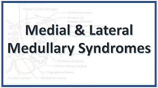 Lateral and Medullary Syndromes  Wallenberg Syndrome  PICA syndrome  Dejerine Syndrome [upl. by Audres]