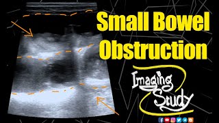 Small Bowel Obstruction  Ultrasound  Case 153 [upl. by Beedon]