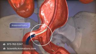 Aortic Aneurysm Repair by Endologix device [upl. by Filler]