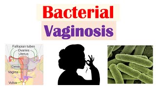 Bacterial Vaginosis Vaginal Infection Causes Risk Factors Symptoms Diagnosis Treatment [upl. by Farnsworth]