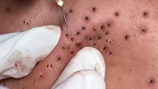 How To Remove Blackheads And Whiteheads On Face Easy 65 ✦ Dr Laelia ✦ [upl. by Oliviero484]