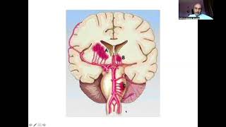 I Teach Medical Students Lacunar Stroke 2 [upl. by Shulman275]