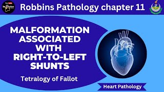 Malformations Associated With RighttoLeft Shunts Tetralogy of FallotRobbins Pathologypathology [upl. by Selry247]