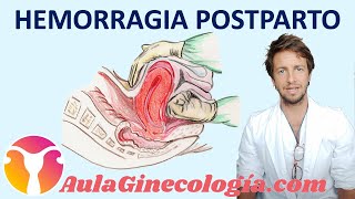 HEMORRAGIA POSTPARTO CAUSAS y TRATAMIENTOS que pueden SALVAR VIDAS  Ginecología y Obstetricia [upl. by Toombs]