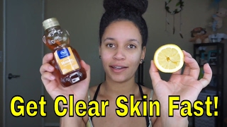 Homemade Honey Facial Mask For Acne  Cassandra Bankson [upl. by Miza]