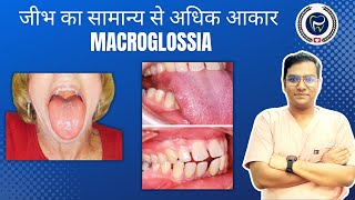 Dr Rudra Mohan  जीभ का सामान्य से अधिक आकार  MACROGLOSSIA  Larger than Normal Size Tongue [upl. by Worden]