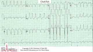 ECG Interpretation Tutorial  ChalkTalk 26 Advanced Level [upl. by Anaderol]