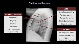 How to Interpret a Chest XRay Lesson 5  Cardiac Silhouette and Mediastinum [upl. by Tammie791]