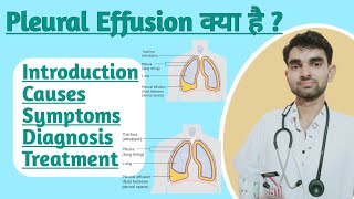 Pleural Effusion in Hindi  Causes Sign and Symptoms Treatment of Pleural effusion [upl. by Ydnim928]