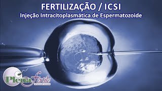 Fertilização in vitro pela ICSI [upl. by Ecnedurp]