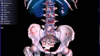 CT SCAN OF VERTEBRAE LUMBAR 3D [upl. by Kennett864]