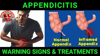 Appendicitis Symptoms and Treatment Options appendicitis [upl. by Arracot500]