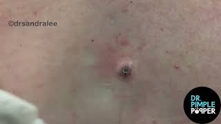 8 MINUTES OF SATISFYING POPS with Dr Sandra Lee  Dr Pimple Popper [upl. by Tully268]