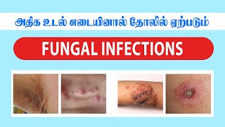 அதிக உடல் எடையினால் தோலில் ஏற்படும் FUNGAL INFECTIONS  JKT SKIN [upl. by Ier]