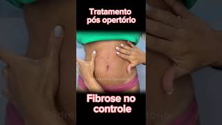 Fibrose pós lipo cadrena pósoperatório lipo lipohd fibrosis flacidez antesedepois estetica [upl. by Norb]