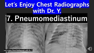 7chestXraychestradiologylungcancerdiagnosis pneumomediastinum 흉부X선胸部X線기종격동気縦隔 [upl. by Werdn986]