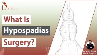 Dr Amit Gupta Explained About Hypospadias  Types Causes Symptoms amp Treatment [upl. by Alderson116]