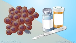 Treating Melanoma [upl. by Rockie659]