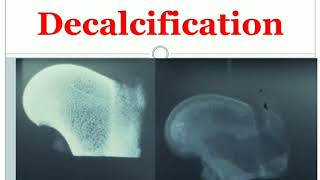 2 Decalcification MLTLectures [upl. by Nanette]