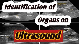 Identification of organs on ultrasoundsonography of liver spleen pancreas kidneys [upl. by Eseryt]