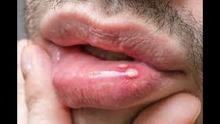 Early Signs of HIV in Men What Symptoms Should You Look out For [upl. by Eniledgam]