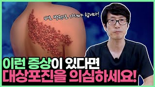 대상포진 초기 증상인지 단순포진 정확히 구분하세요 [upl. by Eledoya632]