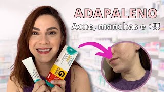 ADAPALENO ACABA COM A ACNE CLAREIA MANCHAS E MUITO MAIS [upl. by Eeldivad412]