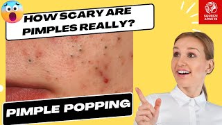 Big Pimples  Acne Treament Under The Skin PimplesAcne Skincare AcneTreatment Blackheads [upl. by Diskson566]