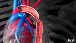 Stenting of Coarctation of the Aorta using a NuMed CP Stent  BVM Medical [upl. by Chelsie]