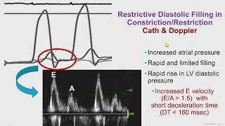 Constrictive Pericarditis [upl. by Sualkin]