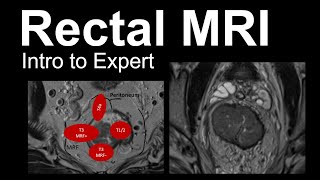 Rectal MRI Intro to Expert Rectal Cancer Staging [upl. by Enimzzaj]