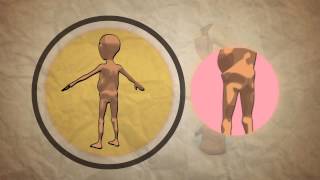 Child Malnutrition  What How And when to Refer [upl. by Yecad]