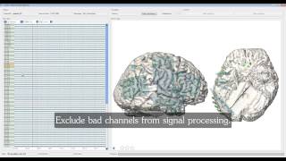 cortiQ  rapid cortical mapping [upl. by Young525]