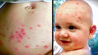 BAD CASE of CHICKEN POX Varicella  Dr Paul [upl. by Mairb]