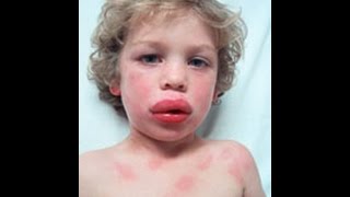 Anaphylaxis and Acute Allergic reaction  How to Help [upl. by Hakon]