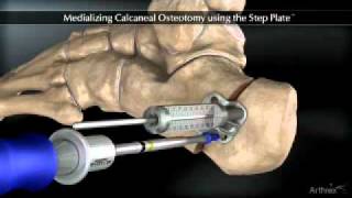 Medializing Calcaneal Osteotomy [upl. by Steck]