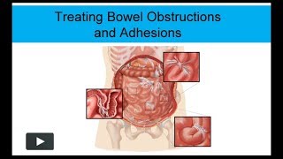 Treating Bowel Obstructions and Adhesions NonSurgically [upl. by Eward]