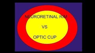 Optic cup Vs Neuro retinal rim [upl. by Rehpotisrhc]