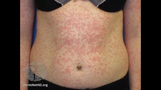 Maculopapular Rash  Causes [upl. by Columbus]