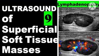 Lymphadenopathy [upl. by Krongold]