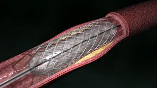 Coronary Artery Angioplasty  Radial Access [upl. by Adina]