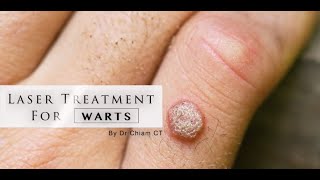 Warts removal with Laser Treatment  Dr Chiam CT [upl. by Karlin]