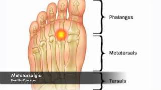 Metatarsalgia Foot Pain Causes Symptoms amp Treatments [upl. by Iral]