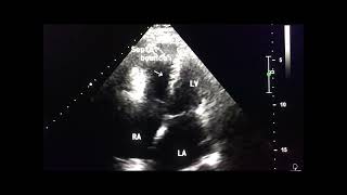 Constrictive pericarditis in echo to drahmadmirdamadisieOUTsC1dOD8fuygn [upl. by Imeaj349]