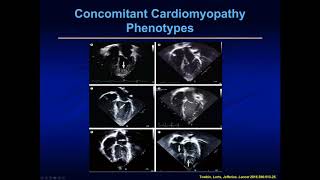 Left Ventricular Non Compaction Cardiomyopathy in Children [upl. by Notxed937]