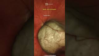 Choroidal Melanoma [upl. by Kevan]