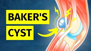 How to ACTUALLY Treat a Bakers Cyst Pain Behind Knee [upl. by Yenot]