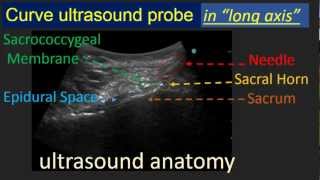 Ultrasound Guided Caudal Epidural Blockmpg [upl. by Anerok]